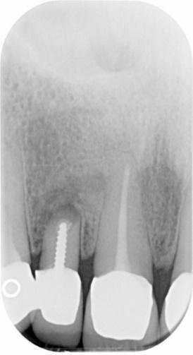 Radiografia 2: dopo la chirurgia.