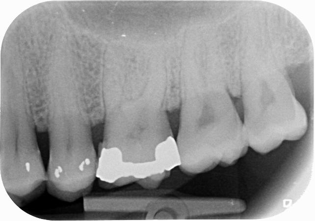 Caso 1: trattamento endodontico di molare superiore di sinistra in pulpite.