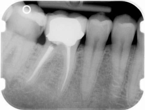 Radiografia 3. Dopo 12 mesi circa circa il granuloma è riassorbito e il tessuto osseo ne ha riempito lo spazio. Incrinature e fratture delle corone dentali.