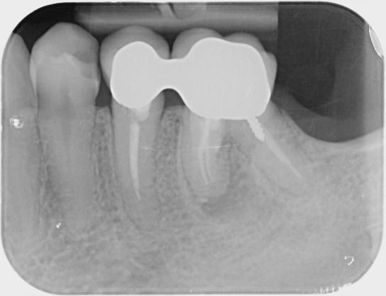 La radiografia evidenzia un granuloma causato da un trattamento endodontico scorretto. Fino allora asintomatico grazie alla fistola, in quella data è esploso dolorosissimo).