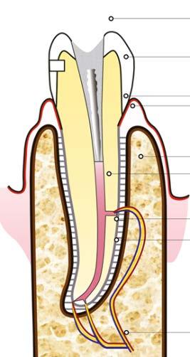 2) la ricostruzione del dente in questo caso fortunato è stata rimossa e si può ora ripulire la parte infetta/tossica (nero).
