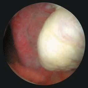 Endoscopia transvaginale TVE La clamp, fissata al labbro posteriore della cervice, serve solo per sollevare la cervice durante il posizionamento del sistema per una corretta visualizzazione e per