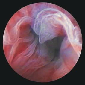 L indagine viene iniziata con la localizzazione della parete uterina posteriore. Poi vengono localizzate le strutture tubo-ovariche tramite rotazione e spostamento laterale dell ottica.