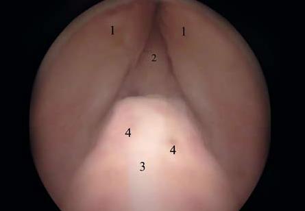 Disturbi minzionali Visione endoscopica dell uretra prostatica: 1) lobi prostatici