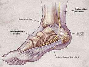 Sindrome del Tunnel Tarsale Mediale EZIOLOGIA: compressione della parte terminale del nervo tibiale posteriormente al malleolo mediale Tunnel Tarsale Mediale: canale osteofibroso formato dal malleolo