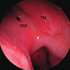 La dissezione anatomica endoscopica de distretto rino-sinusae 11 Ruotando ancora di 45 in senso opposto si ritorna ad osservare: a morfoogia de setto nasae nea porzione media e posteriore, passando