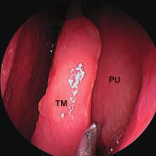 12 La dissezione anatomica endoscopica de distretto rino-sinusae 3.3 III tempo Dopo aver nuovamente retratto endoscopio fino aa vavoa nasae anteriore, ci si approfonda impegnando i meato medio.