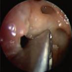 20 La dissezione anatomica endoscopica de distretto rino-sinusae 6.2.2 Dissezione Dopo aver eseguito uncinectomia parziae/totae si espone ostio naturae de seno masceare.