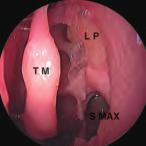 BE = bua etmoidae, S. MAX = seno masceare Fig. 41 Fossa nasae sinistra.