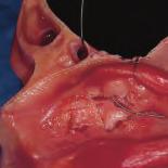 La dissezione anatomica endoscopica de distretto rino-sinusae 23 6.4 