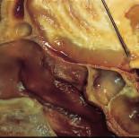 28 La dissezione anatomica endoscopica de distretto rino-sinusae TI EP TS TM AEP AF SS Fig. 58 Preparato anatomico sezione sagittae.