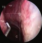 6.2 Dissezione L approccio dissettorio ao sfenoide è dupice: i seno può essere raggiunto per via endo-nasae (parasettae diretta) o per via trans-etmoidae.