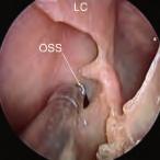 OSS = ostio naturae seno sfenoidae LC = amina dei cornetti emtoidai Fig. 69 Fossa nasae sinistra.