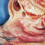 8 La dissezione anatomica endoscopica de distretto rino-sinusae SF TI TM TS Fig. 1 Preparato anatomico sezione sagittae paramediana.
