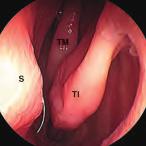 1 I tempo I primo tempo de endoscopia diagnostica viene eseguito mediante introduzione de endoscopio (30, diametro 2,7 mm) in un piano paraeo a pavimento nasae (fig. 1).