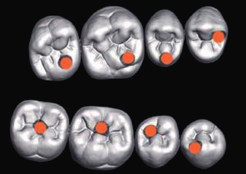 risultati in: PROTESI TOTALE PROTESI OVERDENTURE TORONTO BRIDGE PROTESI SU BARRA Il taglio di colletto, dentina e smalto in