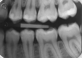 perpendicolare alla faccia vestibolare del dente NB è importante che i raggi siano paralleli al