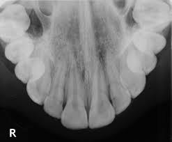 D D S Lo status radiografico Consiste nello studio di tutta la dentatura con una serie completa di radiogrammi endorali.