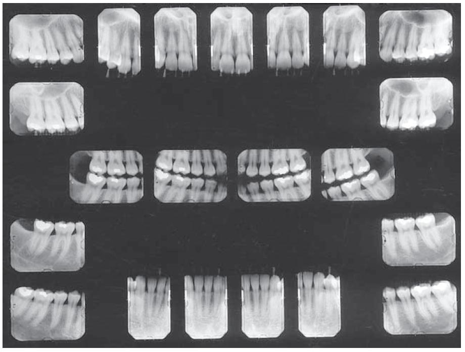 Lo status radiografico Consiste nello studio di tutta la dentatura con una serie completa di radiogrammi endorali.