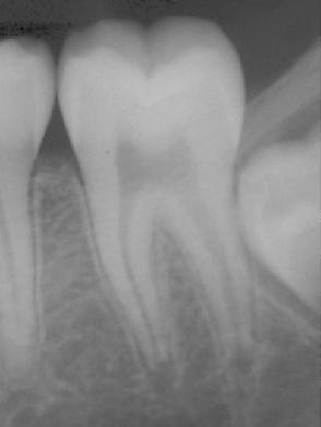 La sostanza fondamentale del dente è la dentina o avorio, ricoperta a livello della radice, dal cemento della stessa densità radiologica della dentina.