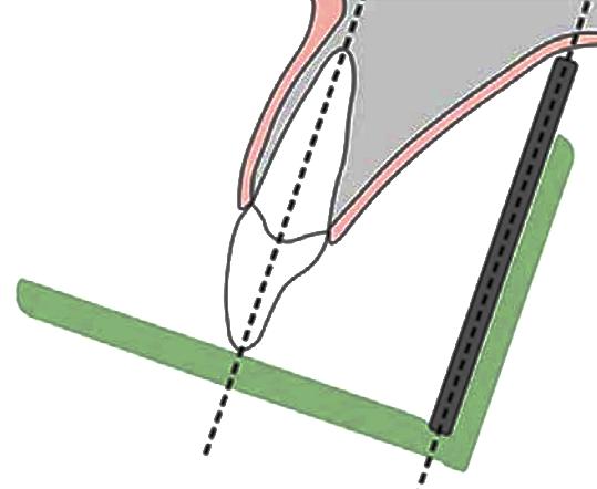 Radiografie periapicali se il sensore è appoggiato a ridosso della gengiva, per essere il più vicino possibile al dente, è inclinato rispetto all asse del dente e quindi