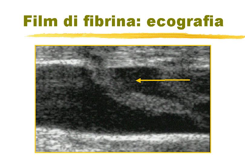 Fibrin sleeve: (Fino al