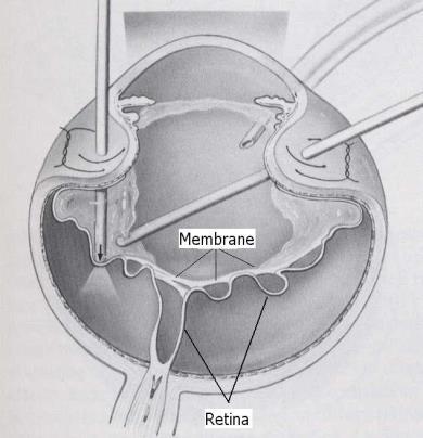 it SCHEDA INFORMATIVA PER INTERVENTO DI VITRECTOMIA PER DISTACCO DI RETINA REGMATOGENO PREMESSA Il distacco di retina regmatogeno è un sollevamento della retina con