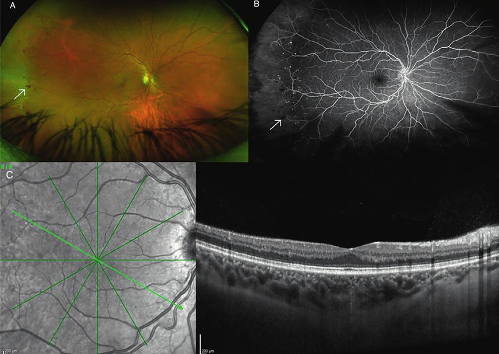 Nosografia, screening e diagnosi della retinopatia diabetica Figura 1. Imaging multimodale di retinopatia diabetica non proliferante senza edema maculare.