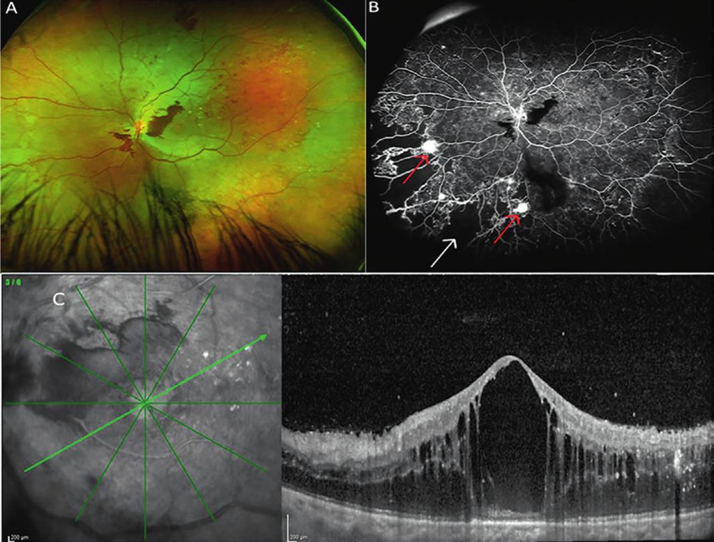 M. Brambati et al. Figura 2. Imaging multimodale in retinopatia diabetica proliferante complicata da edema maculare.