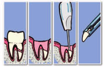 denti. Durante l estrazione residui di radici possono restare fermamente alloggiati nel legamento parodontale.