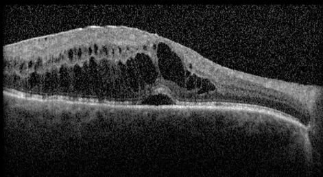 5.1 Retinopatia diabetica non proliferante