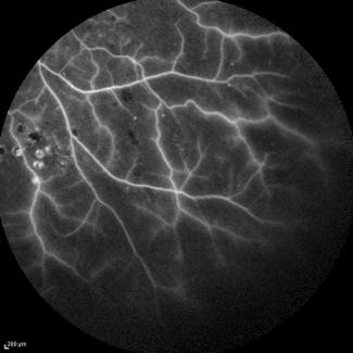 5.3 Edema diffuso/focale