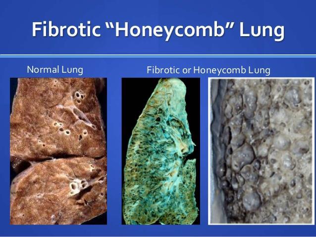 differenziale della fibrosi polmonare (biopsie