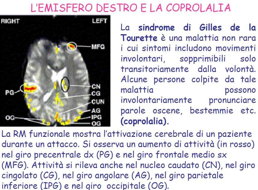 PROSODIA, EMISFERO DESTRO E SINDROME DI GILLES DE LA TOURETTE PROSODIA insieme di tratti fonetico-fonologici (tra cui: accento, quantità, tono, sillaba, giuntura, intonazione e ritmo) che determinano