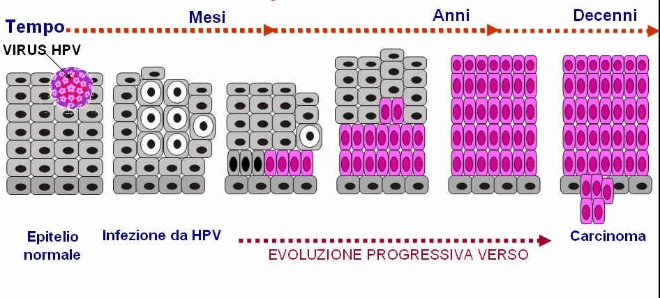 Come si sviluppa il cancro della cervice?