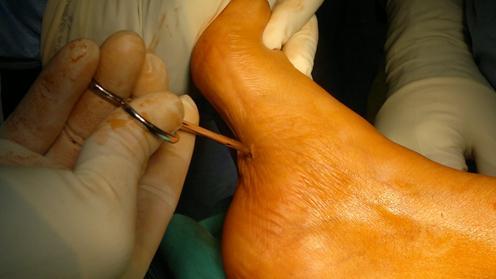ausili, in particolare i plantari e ortesi gamba-piede, possono aiutare i pazienti ad