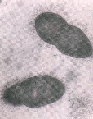 Streptococcus pneumoniae (Pneumococco) o Ha elevato tasso di letalità (soprattutto nella popolazione anziana), un esordio brusco con febbre alta, stato di letargia oppure di coma e con segni di