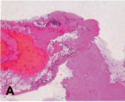 del core ricco di lipidi (cellule schiumose e lipidi extracellulari) al flusso ematico, promuovendo l attivazione e l aggregazione piastrinica con attivazione della Trombina e formazione del trombo