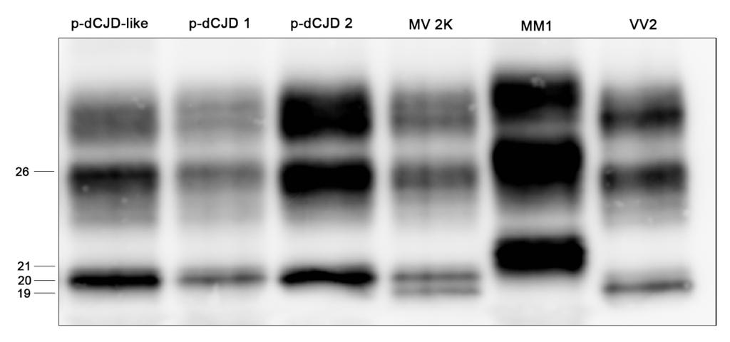 RISULTATI 1. TIPIZZAZIONE BIOCHIMICA DELLA CJD Figura 16: Western blot della PrP Sc associata al fenotipo p-dcjd e simili (MMiK), a confronto con la PrP Sc tipo 1 (21 kda, scjdmm1), tipo 2 (19 kda.