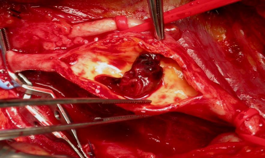 Arteriopatia periferica e carotidopatia Oltre
