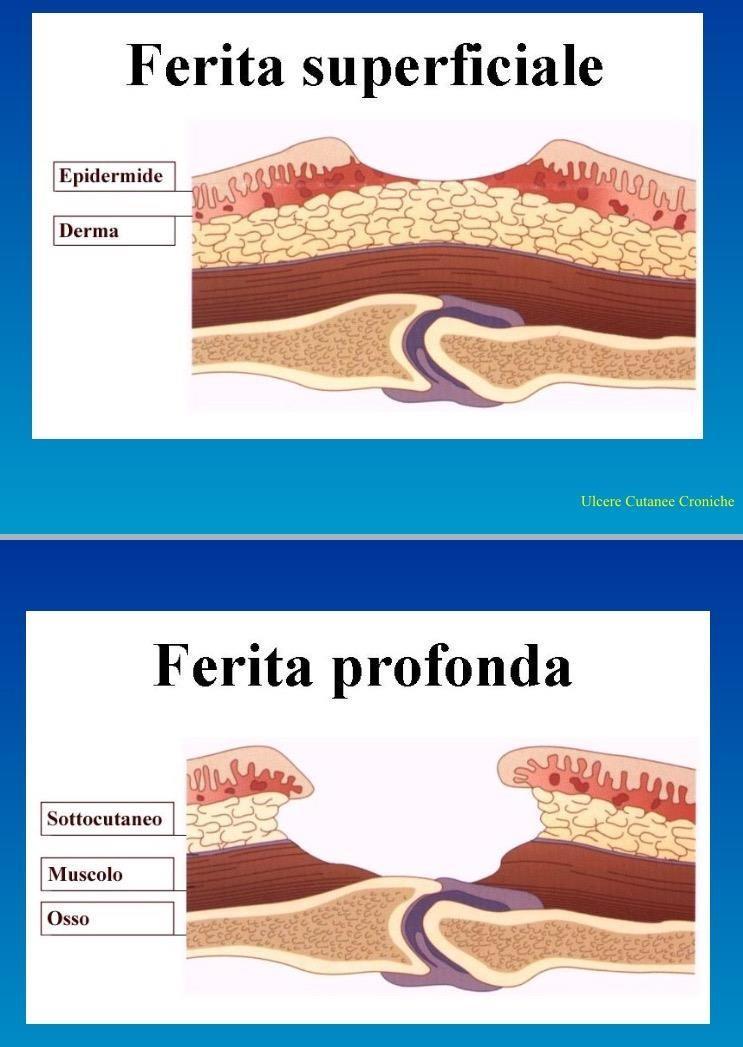 rimodellamento"» La lesione deve interessare almeno il derma papillare» La lesione cutanea