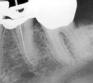 Radiografia di una lima n 10 (b) nel canale linguale. Si noti come la lima segue la curvatura della radice apparendo essere all interno del canale.