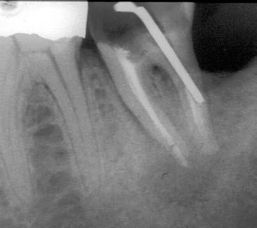 L Informatore Endodontico Vol. 4, Nr. 2 2001 Figura 4 La radiografia mostra la sospetta perforazione da perno. Si noti la patologia preapicale.