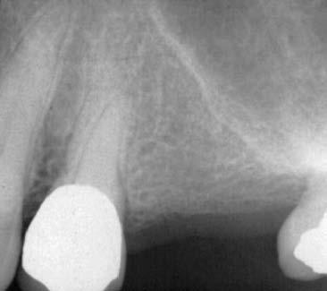 La radiografia mostrava che i canali erano completamente calcificati (Fig. 6). Con l aiuto del microscopio operatorio fu iniziata la terapia endodontica.