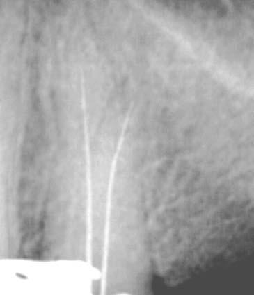 L uso dei localizzatori apicali nella diagnosi delle perforazioni 7 8 Figura 7 Una lima è inserita all interno del canale ed è collegata ad uno degli elettrodi del localizzatore apicale.