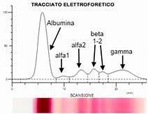 Tracciato di un elettroforesi sieroproteica A) Gel di agarosio B) Elettroforesi capillare C)