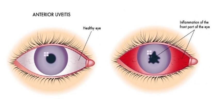 Uveite autoimmune Oftalmite simpatica: l intera uvea (tonaca vascolare dell occhio) sviluppa una