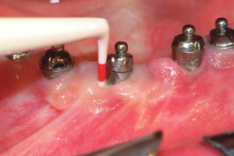 Dental Clinics PERIODICO DI ODONTOIATRIA GENERALE La prevalenza della perimplantite è pari al 28%-56% dei soggetti a seconda degli studi considerati.