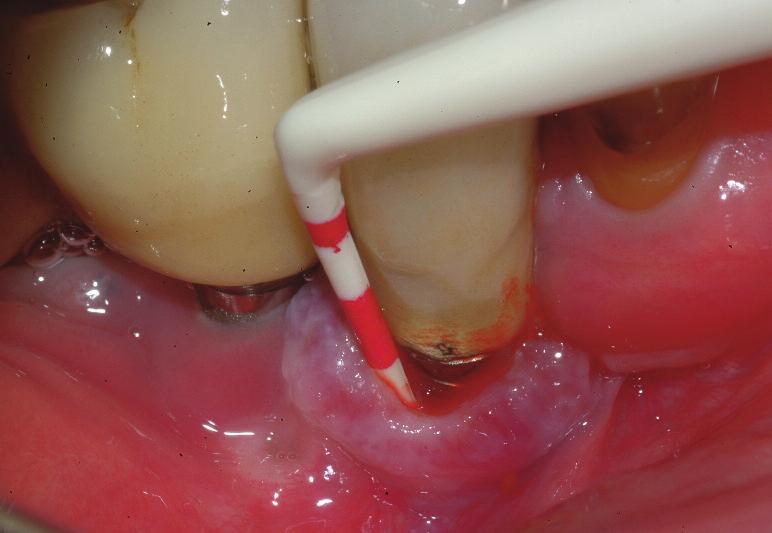 IMPLANTOLOGIA Figura 2 Perimplantite in fase acuta con sanguinamento al sondaggio. Figura 3 Perimplantite con tasca di 5 mm. plantite.