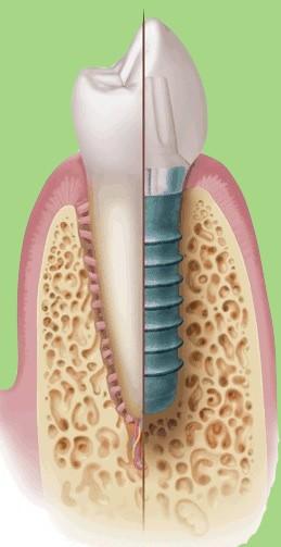 Rigenerazione denti ed impianti Trattare Parodontite e Perimplantite Relatori: Dr. Massimo Di Stefano Dr.